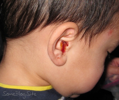 picture of an ear bleeding due to an infection