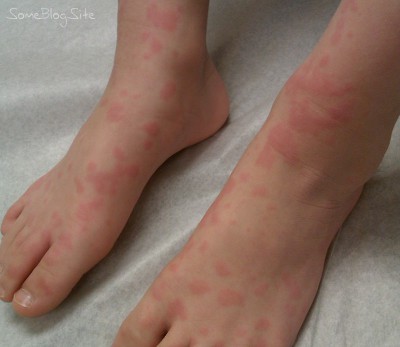 photo of food allergy hives on a child's feet and ankles