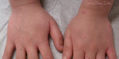 photo of food allergy hives on a child's feet and ankles
