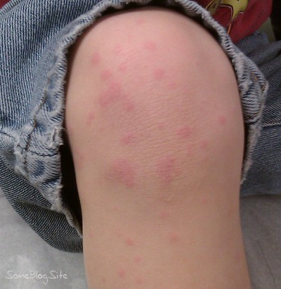 photo of food allergy hives on a child's knees