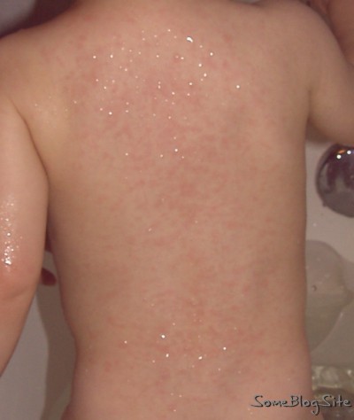 roseola rash on the back of Alpha