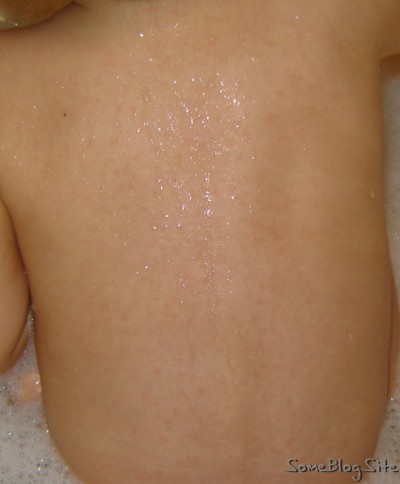 roseola rash on the back of Beta