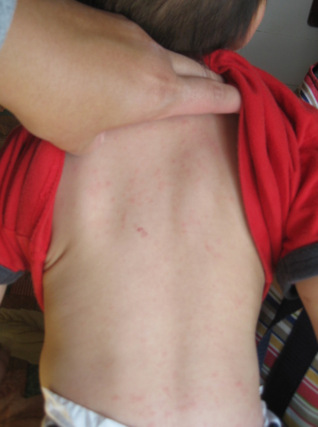 roseola rash on the back of a 16-month-old child