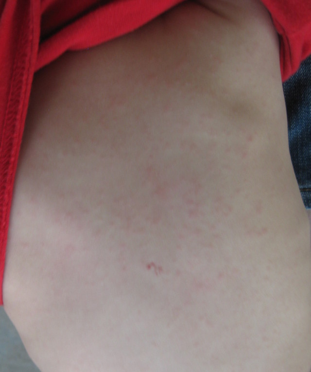 roseola rash on the back of a 16-month-old child
