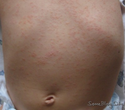roseola rash on the back of Gamma