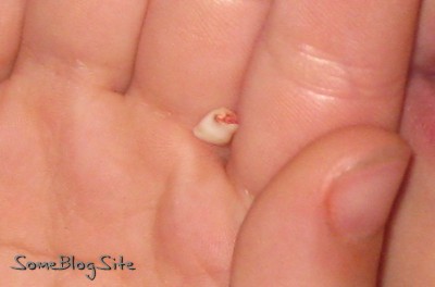 photo of a baby tooth that has been lost