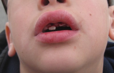 picture of dried blood on gums