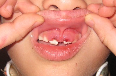 picture of the gums after teeth were pulled
