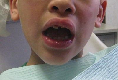 picture of mouth of a child in the dentist's chair