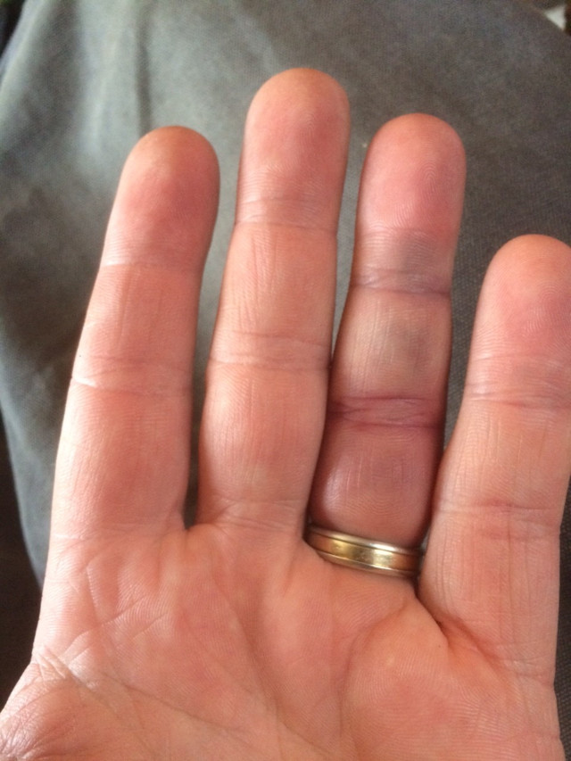 image of a jammed finger that has swollen