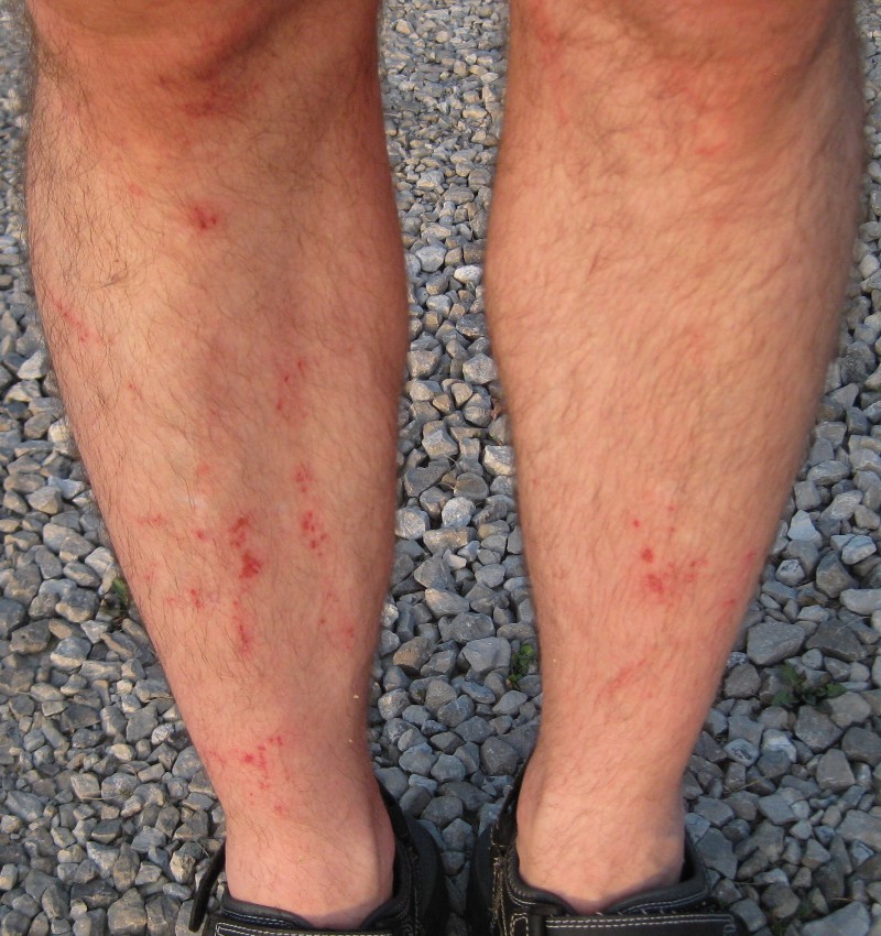 List 90+ Images pictures of cuts on legs Excellent