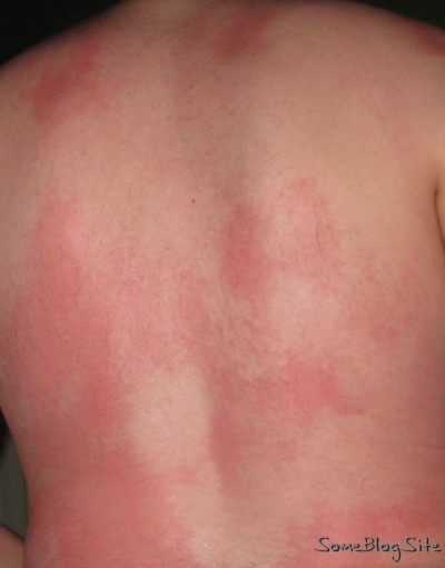 partially-sunburned back