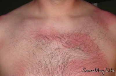 partially-sunburned chest