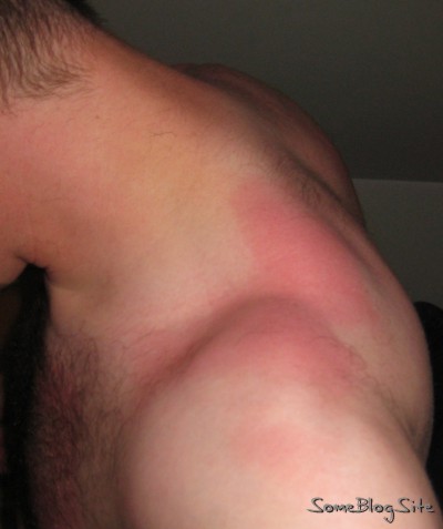 partially-sunburned shoulder
