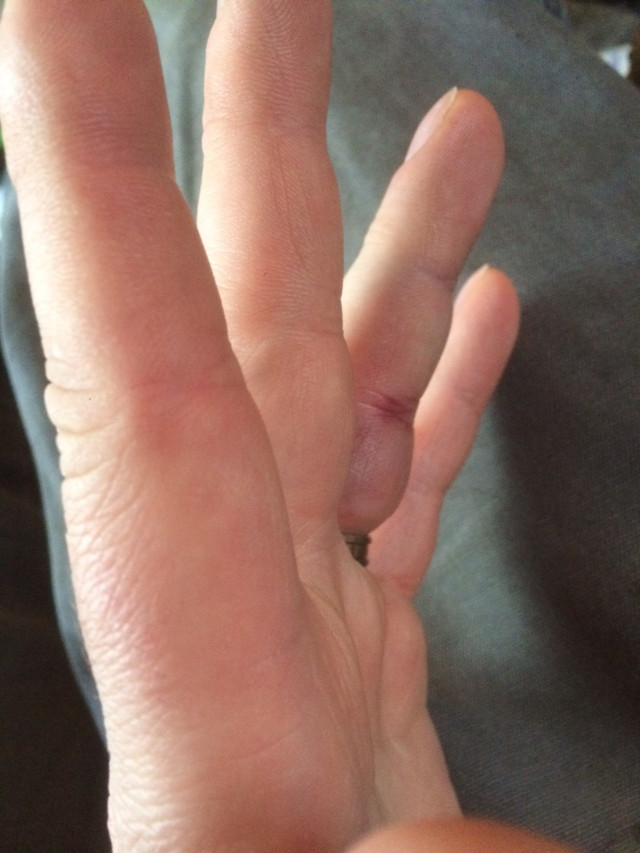 image of a jammed finger that has swollen